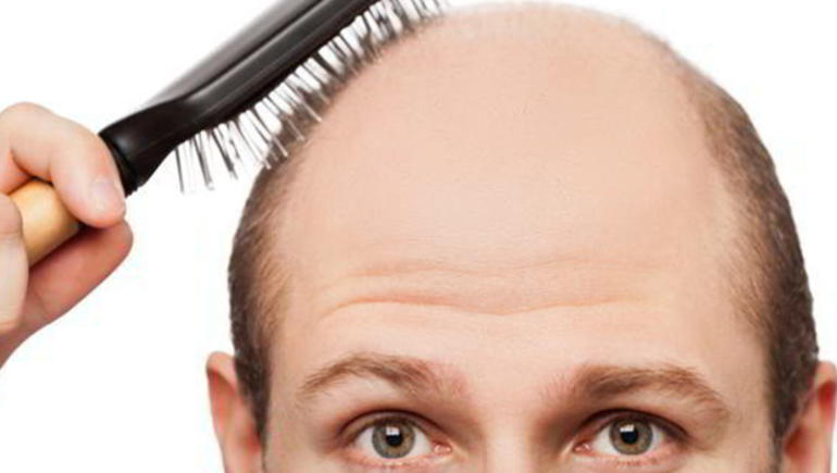 Erkeklerle Saç Dökülmesi Sebebi ve Önlemi